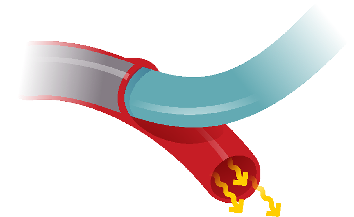 Illustration of acute limb ischemia and compromised blood flow to the leg